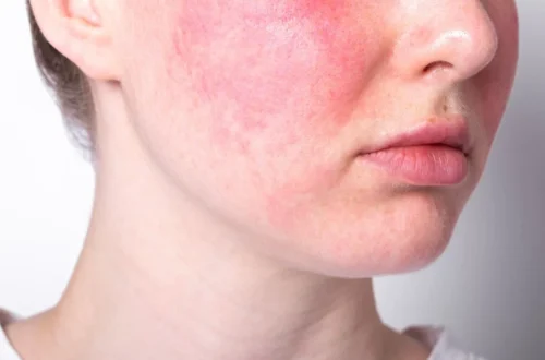 Stymulatory tkankowe w terapii trądziku różowatego