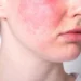 Stymulatory tkankowe w terapii trądziku różowatego